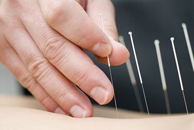 brug akupunktur mod soevloeshed